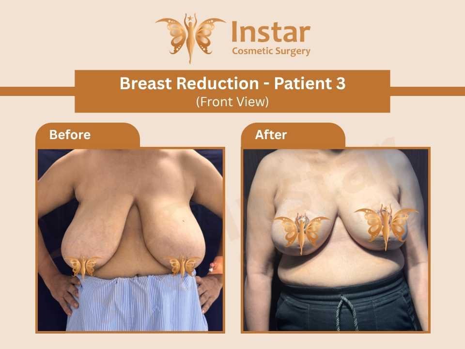 Breast Reduction (Front View)